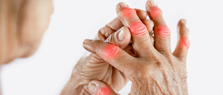 Blog of Supplements for Gout: Change Your Relationship with Gout for Good which have image gout pain points on hands highlighted in red