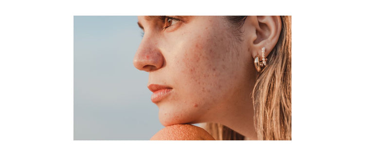 Blog of Understanding the Link Between Gut Health & Acne which have image woman with acne on cheeks