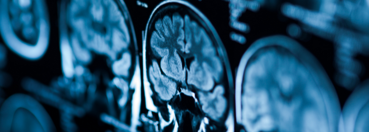 Reversing Cognitive Decline: Why the Vascular System Holds the Key