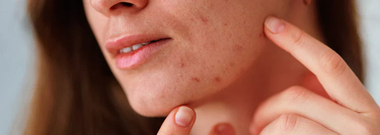 Blog of The Ultimate Guide to Hormonal Acne Supplements: Science-Backed Solutions for Clear Skin which have image The Ultimate Guide to Hormonal Acne Supplements: Science-Backed Solutions for Clear Skin